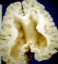 idrocefalo pazienti idrocefalici tecniche di guarigione e chirurgiche